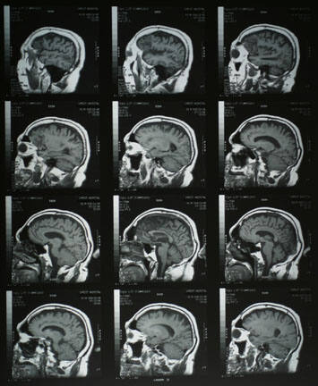 Untitled M.R.I. study of  an anonymous patient who suffered a stroke